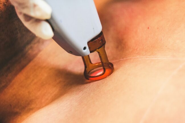 BareHR laser hair removal treatment for smooth skin at The Fitz Aesthetics in Edmond OK